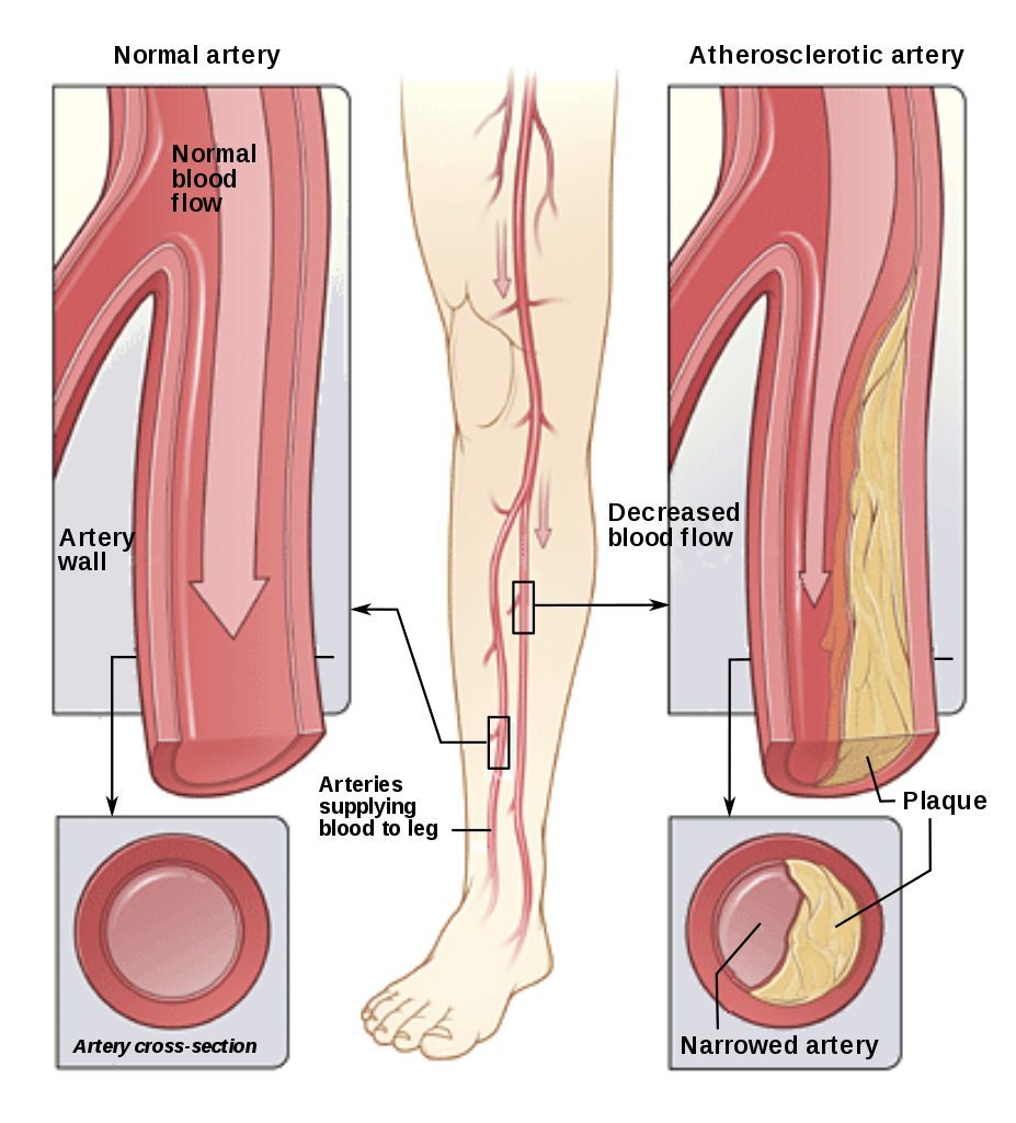 peripheral artery disease research paper